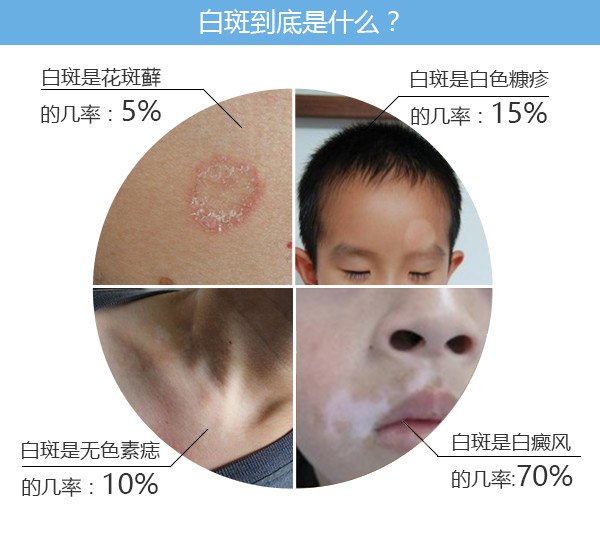儿童白癜风治疗